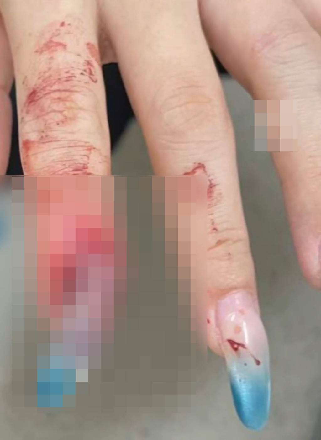 做了美甲後的王女士跌倒，手指骨出現折斷。九派新聞