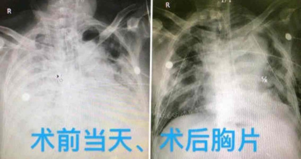 手術前後。網圖
