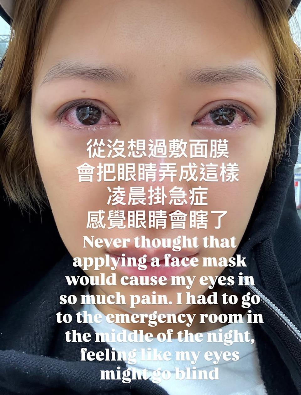 上月倪晨曦敷面膜,致雙眼通紅劇痛險失明。 上月倪晨曦敷面膜,致雙眼通紅劇痛險失明。
