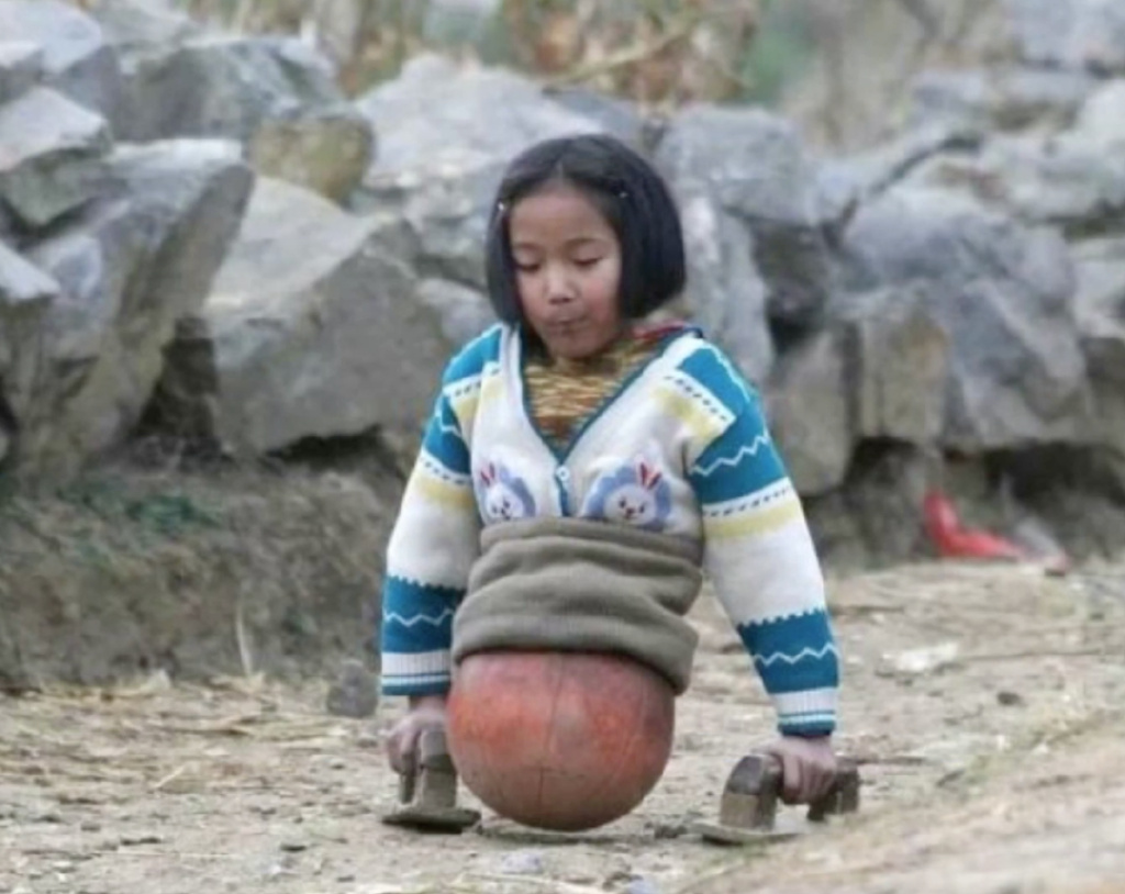 錢紅艷小時靠爺爺給她造的特製籃球拄著木手墊挪動身體。
