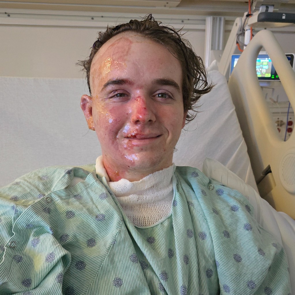 史密斯(Jacob Smith)傷勢嚴重,他說與犯案者無過節,不知為何被淋滾油。 GoFundMe 史密斯(Jacob Smith)傷勢嚴重,他說與犯案者無過節,不知為何被淋滾油。 GoFundMe