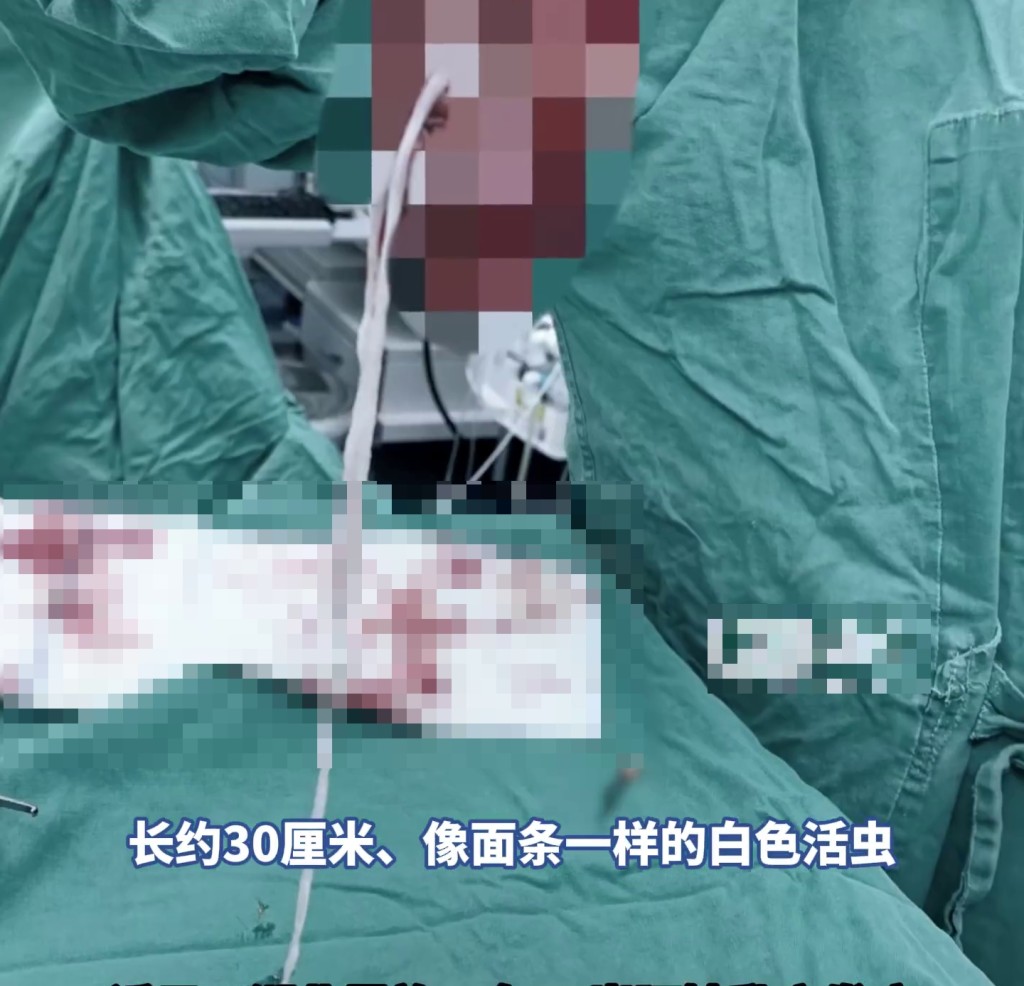 七旬妇乳房藏30cm活虫，医生成功取出。 极目新闻