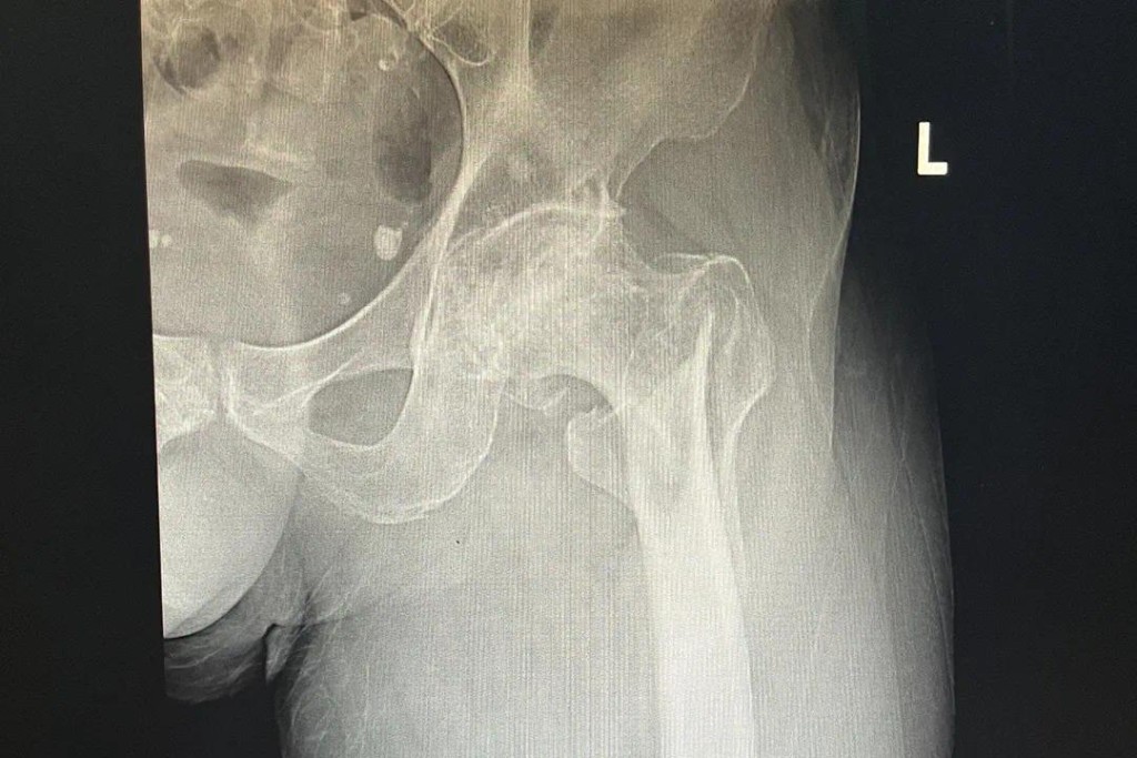 手术前X光片。 
