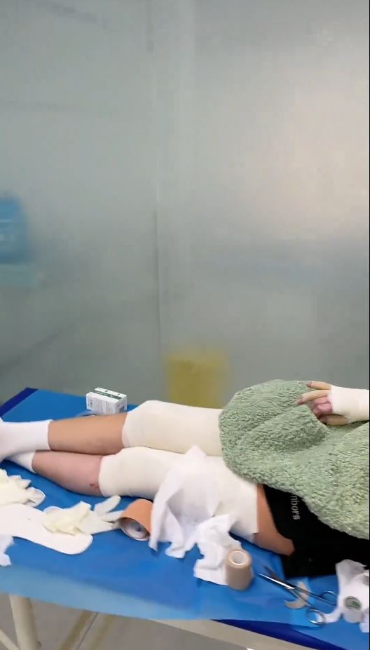 湖北女手機放枕邊通宵叉電，因充電器爆炸燒傷7成皮膚毀容。抖音＠依依的抗疤分享