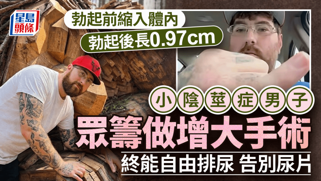 美國男自稱下體全球最短「勃起不到1cm」 眾籌做增大術告別失禁
