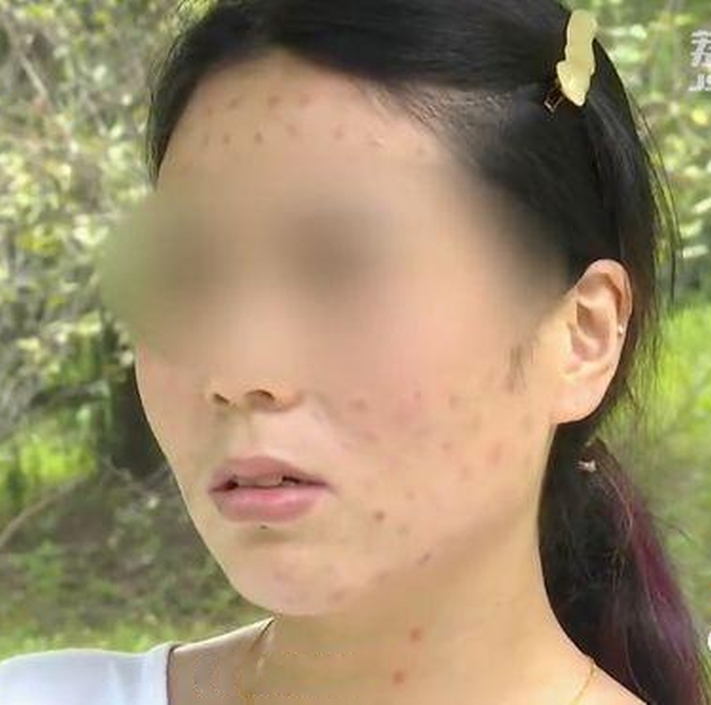 陳女士的臉上被打了200多針。