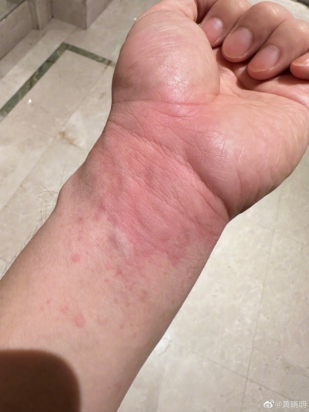 黄晓明最近返青岛叹不少家乡菜后，手臂却出现急性荨麻疹。