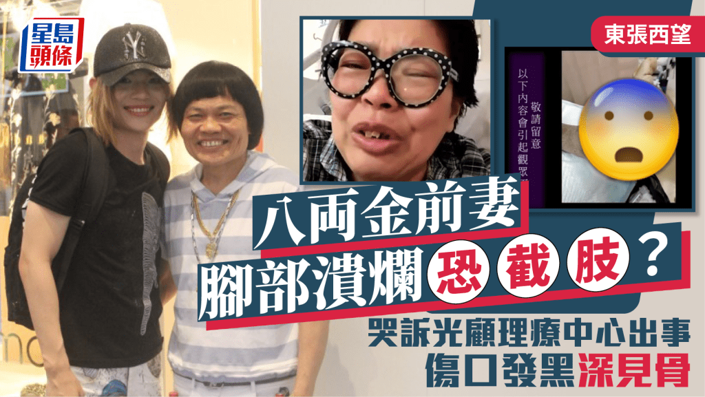 東張西望丨八両金前妻腳部潰爛恐要截肢？哭訴光顧理療中心出事 傷口發黑深見骨