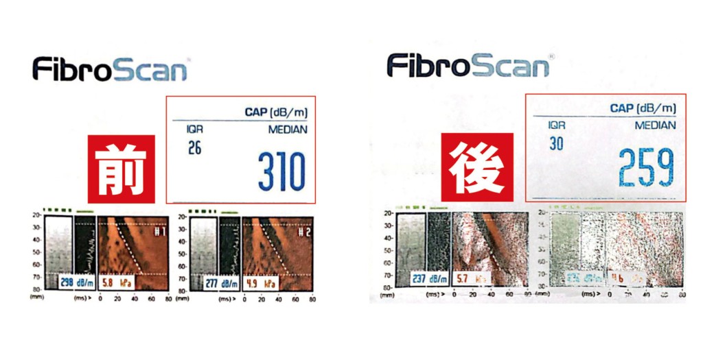 病人在服用益生菌前的CAP指數是310，三個月後CAP指數回落至259，肝脂由重度降至輕度。