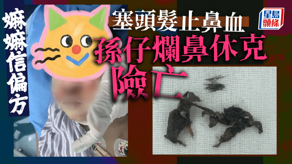 長者給男童鼻腔塞頭髮止血致休克。