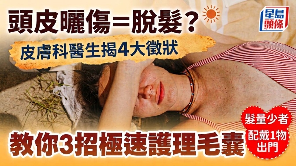 炎热天气头皮晒伤 皮肤科医生揭4大征状 教你3招极速护理毛囊 发量少者配戴1物出门