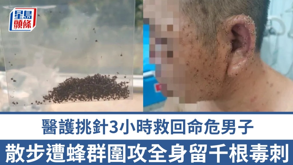 湖北男遭蜂群圍攻險死，3醫護花3小時拔刺撿回一命。