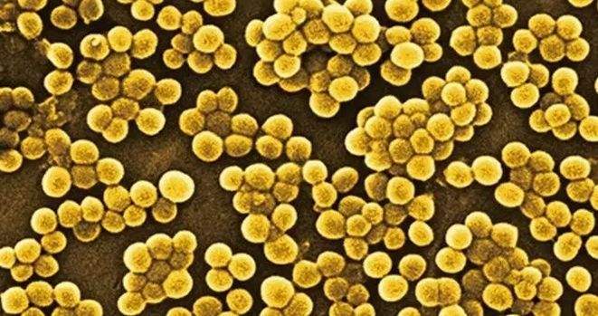 醫生懷疑是金黃色葡萄球菌導致肺炎。