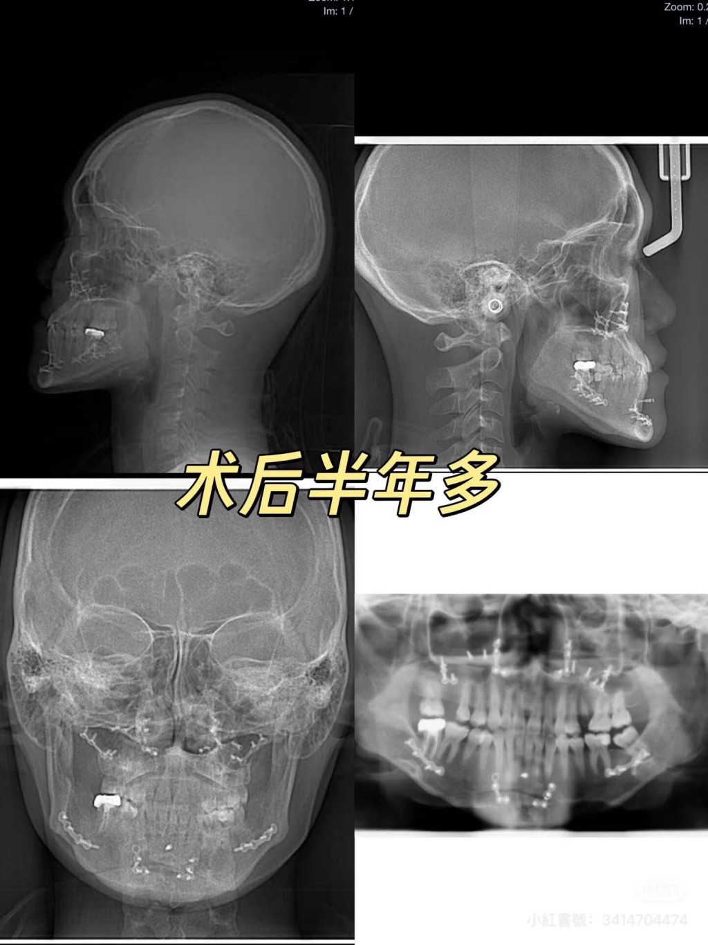 术后检查记录。