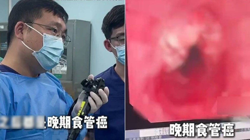 河南有醫院在一個上午，確診11名晚期食道癌患者。小莉幫忙