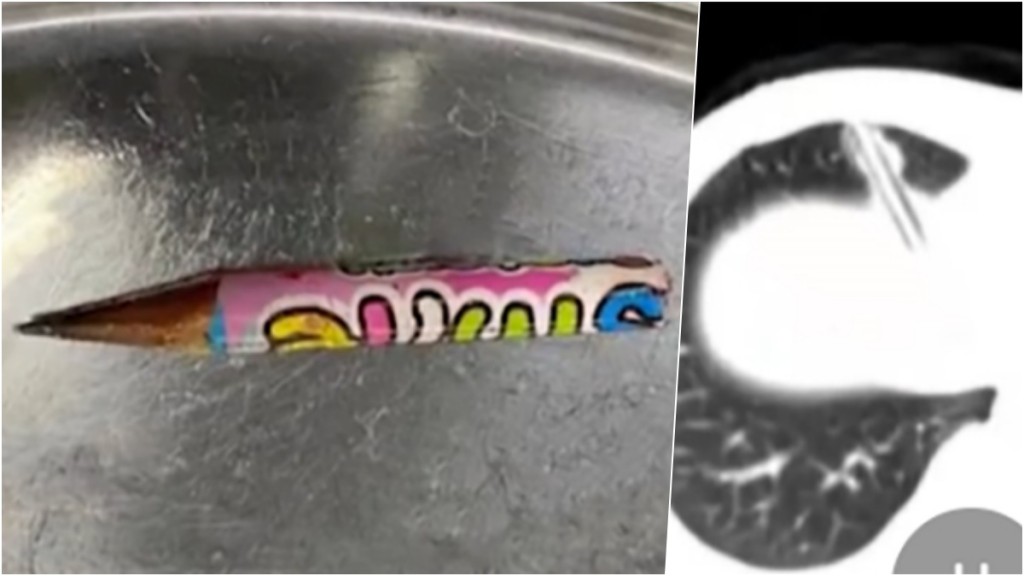 江蘇女童玩耍跌倒，手中鉛筆直插胸腔，半截斷體內。 網圖