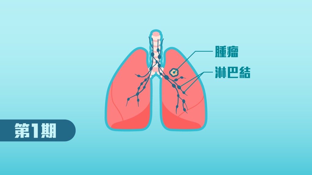 肺癌初期（第1期）