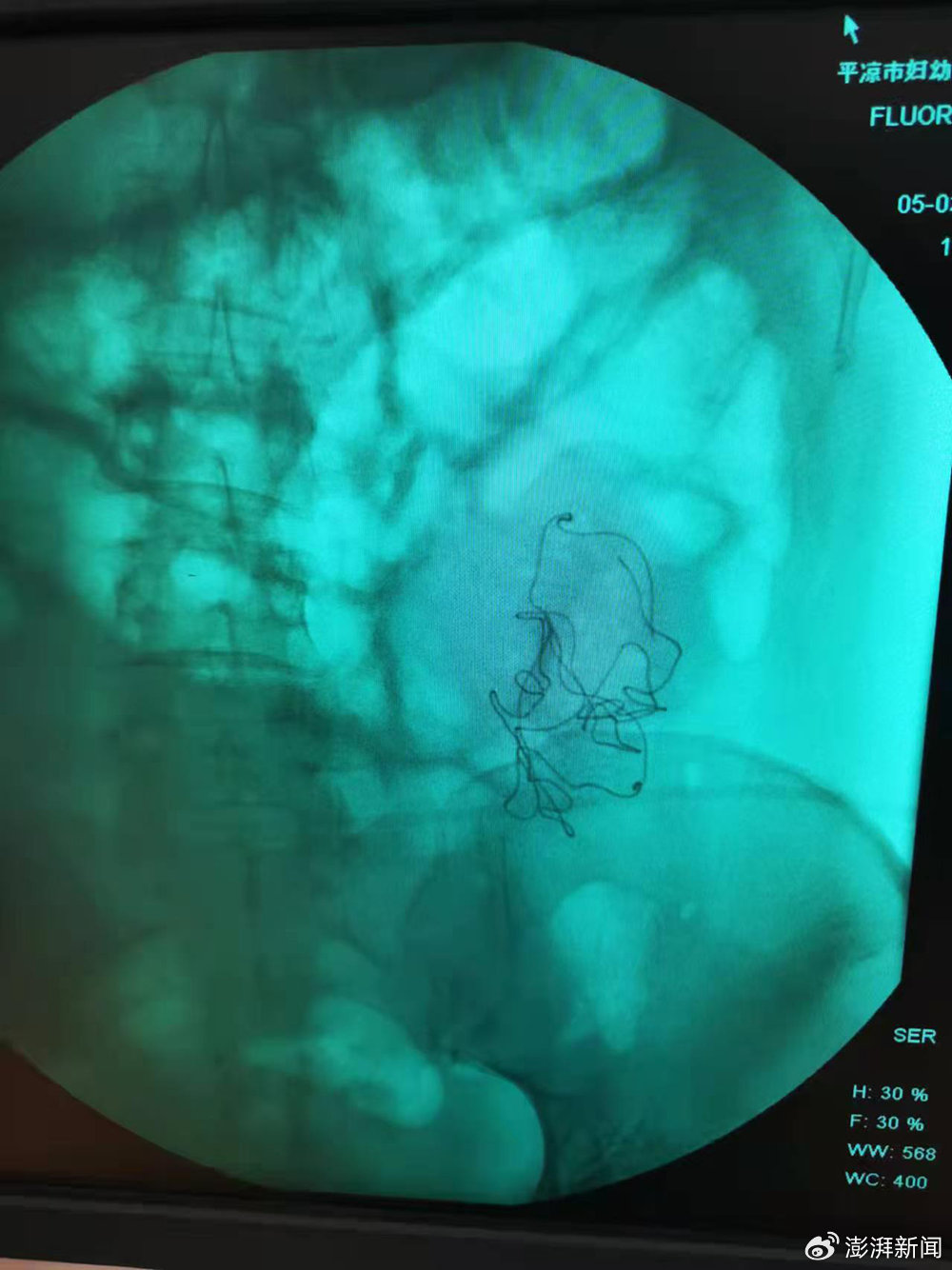 秦红利分娩后，进行X光检查发现异物清晰可见。澎湃新闻