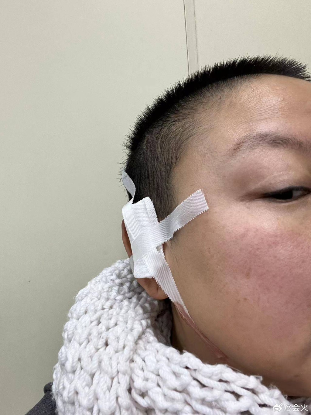 網路上也流出王韵壹去年包紮右耳靠近太陽穴位置受傷的照片。