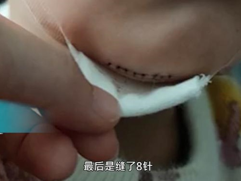 男童為頦部軟組織破裂3厘米,需縫八針。網圖