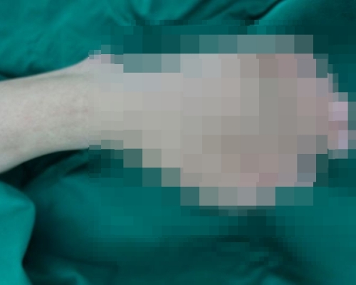 廣東潮汕一名21歲男子左腳從出生起就患有「多趾畸形」，一腳竟有9隻腳趾。 網圖