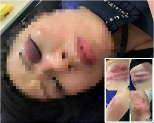 二人遭打至傷痕纍纍。網圖