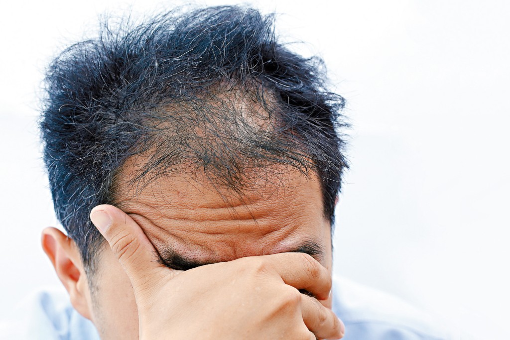 香港人生活節奏急速而且壓力大，這亦導致許多人因而脫髮。