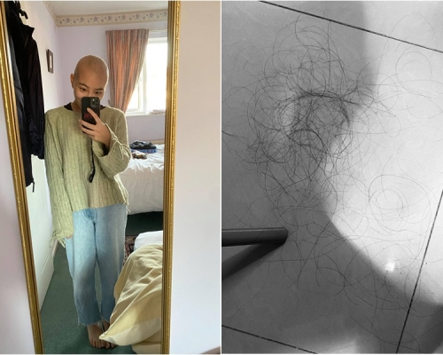 王卓雅病困變禿頭。facebook圖片