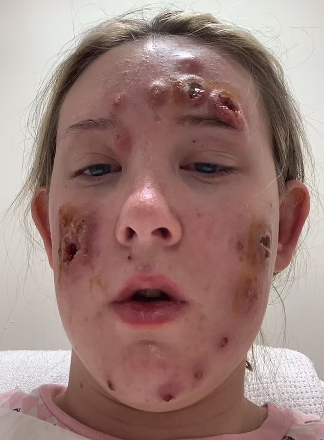 女子罹患罕見的壞疽性膿皮症，臉上造成一個一個的大洞，且不停流膿滲血。網圖