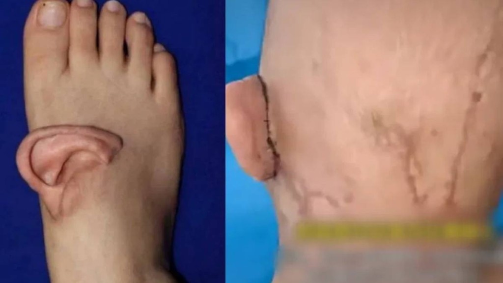 山東婦人意外被扯斷耳,寄養腳背5個月後歸位。齊魯晚報