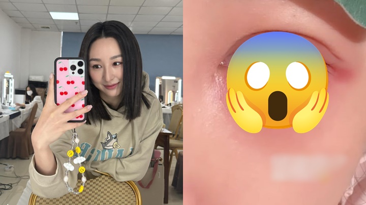 高海寧長達一年受眼疾困擾，大呻又痕又痛好辛苦。