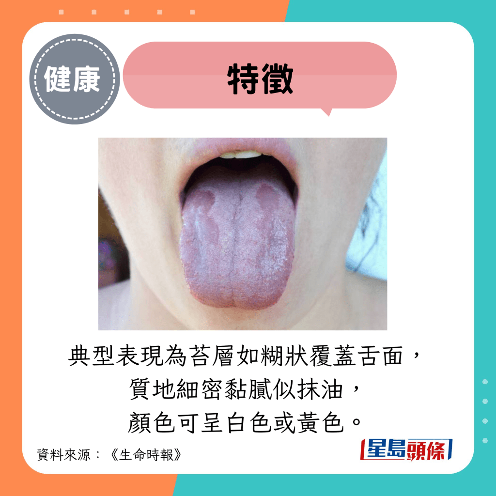 特征：典型表现为苔层如糊状覆蓋舌面， 质地细密黏腻似抹油， 颜色可呈白色或黄色。