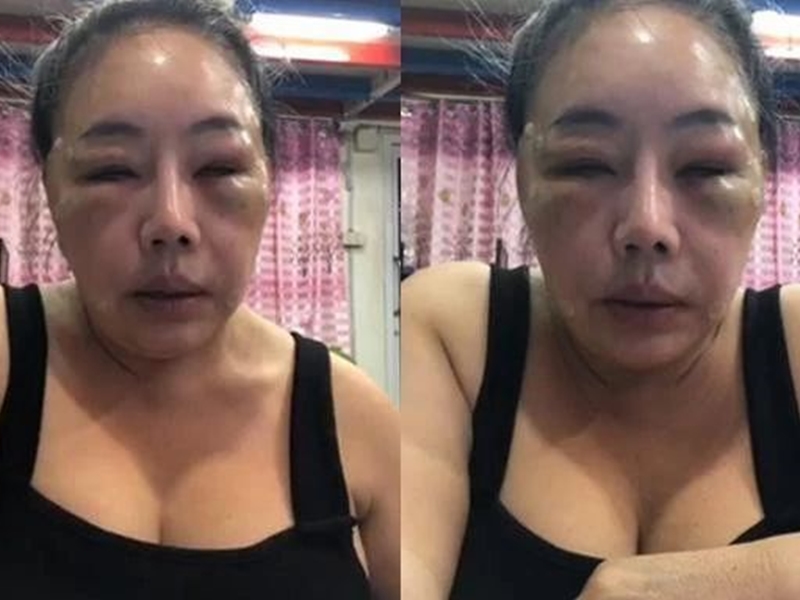 莉娜貼出自己整容後的照片 網圖