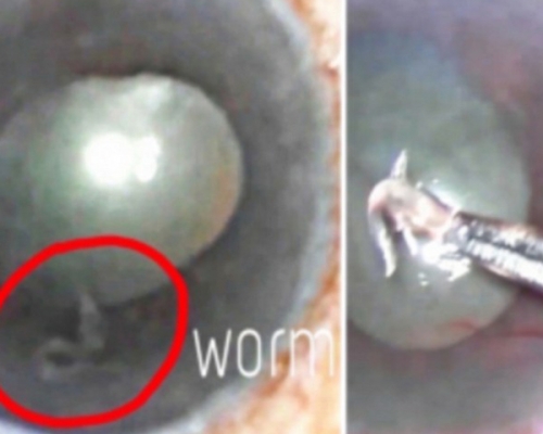 婦人眼內有一條長約1厘米又名眼絲蟲的羅阿羅阿絲蟲（Loa loa）（紅圈）。 網圖