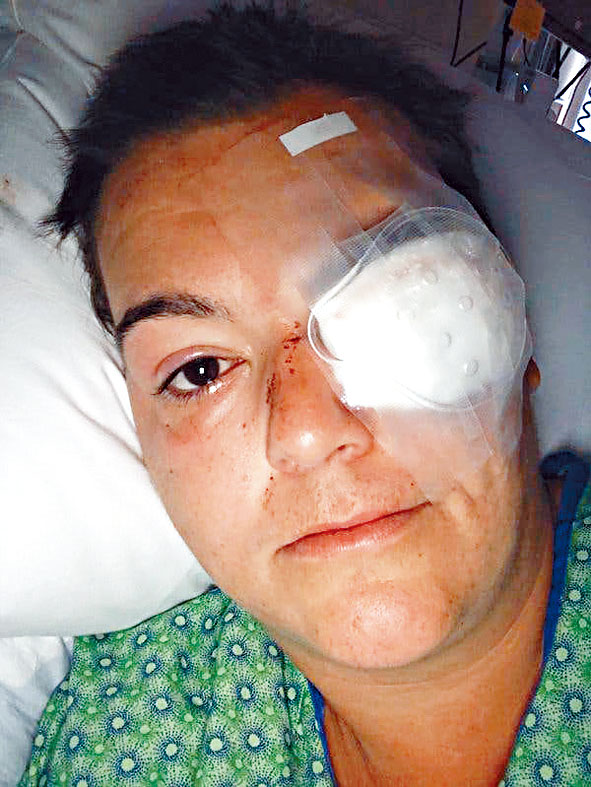 自由攝影記者蒂拉多左眼被警方射中。