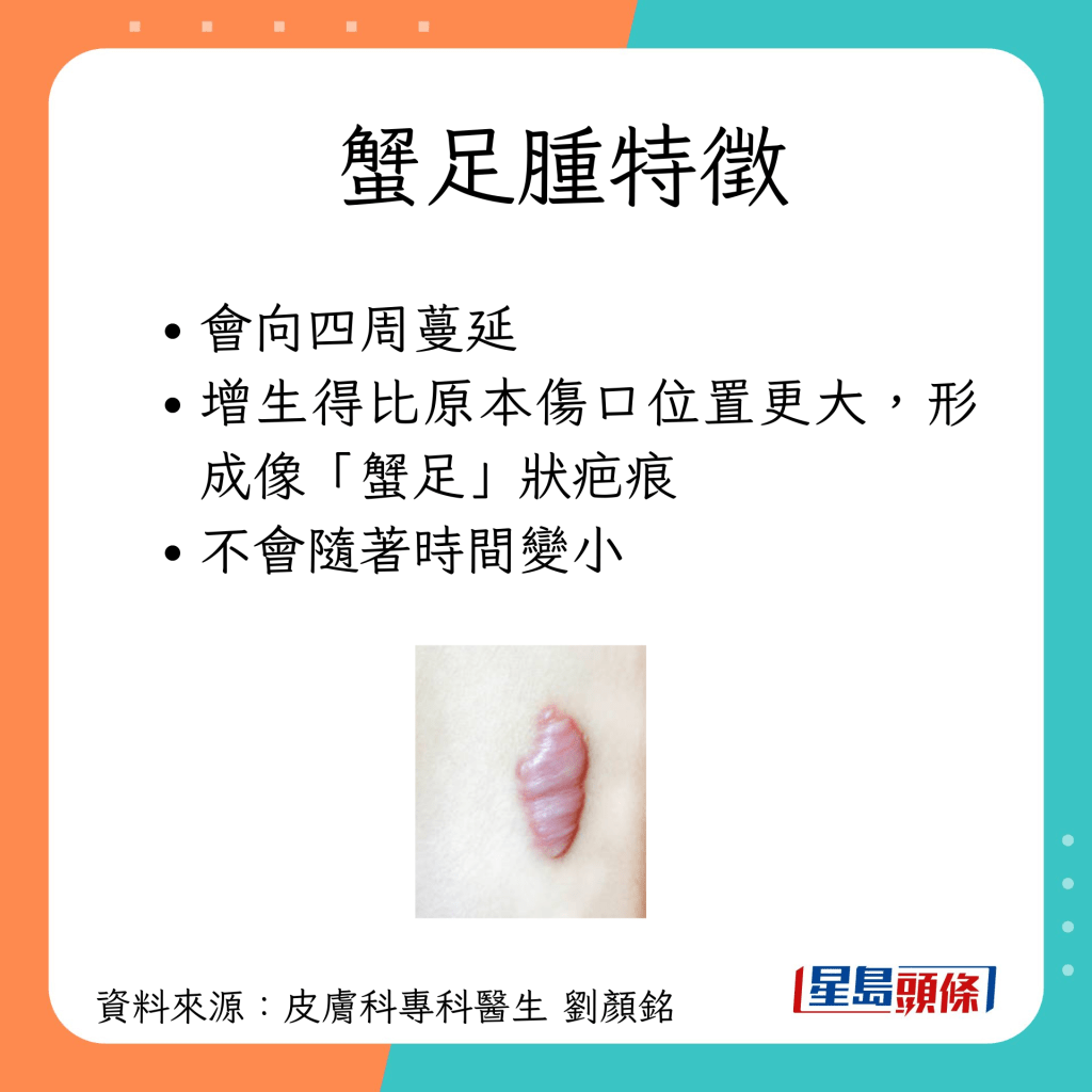 蟹足腫特徵