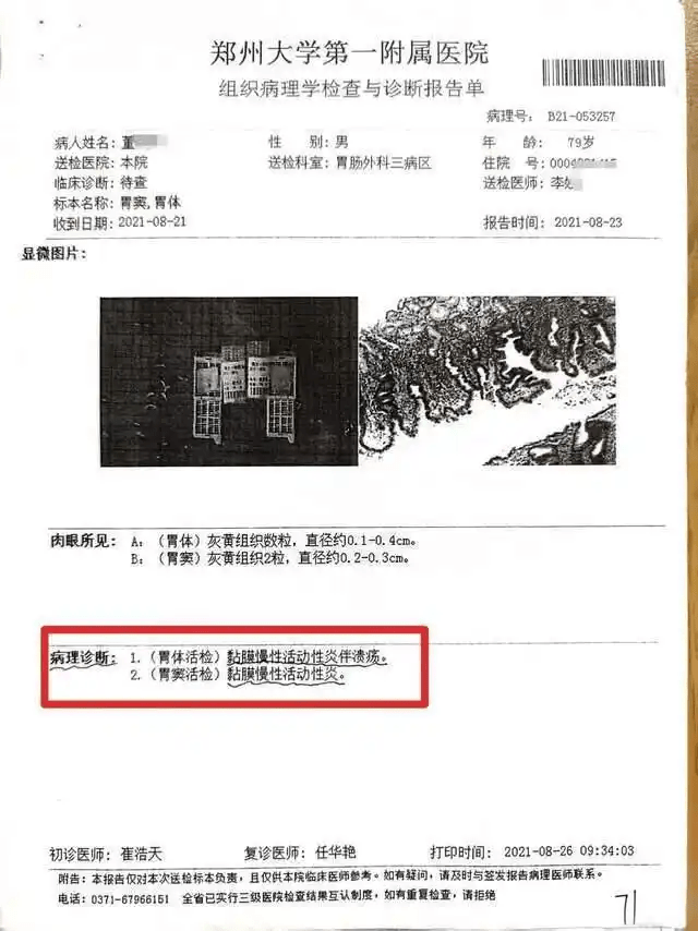 術後兩次做病理學檢查,均顯示非胃癌。 術後兩次做病理學檢查,均顯示非胃癌。