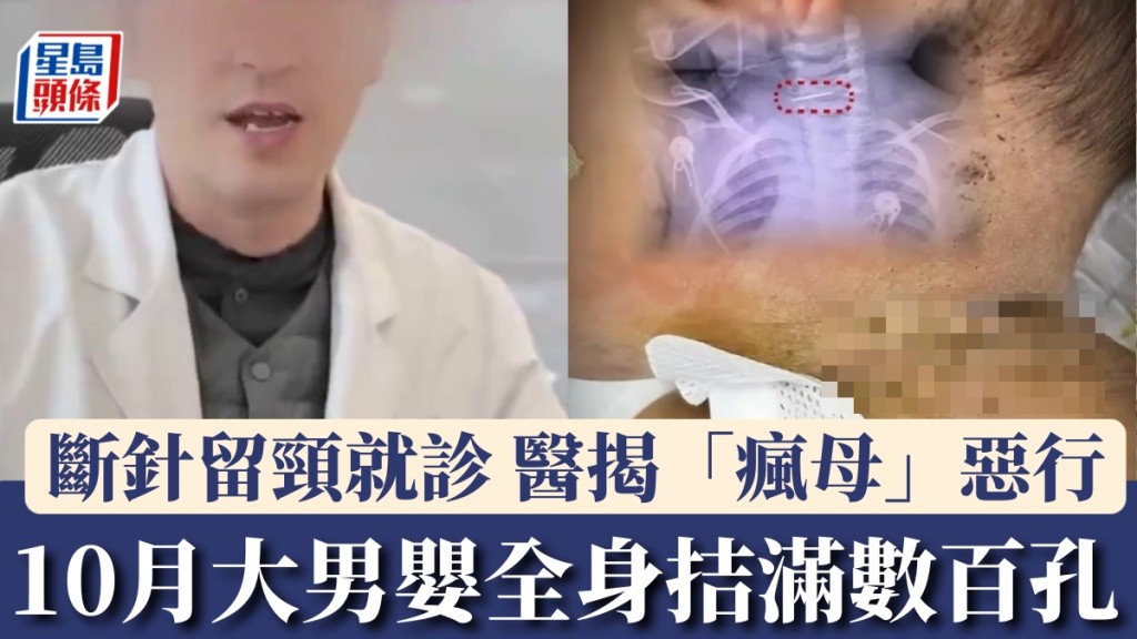 10月大男嬰全身慘遭拮滿數百孔，斷針留頸就診，醫生拍片揭「瘋母」惡行。