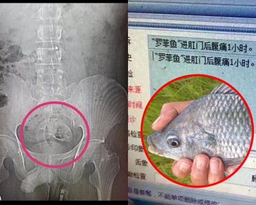 男子肚痛就診,肛門內發現整條鯽魚,稱不小心坐到魚上。(網圖)