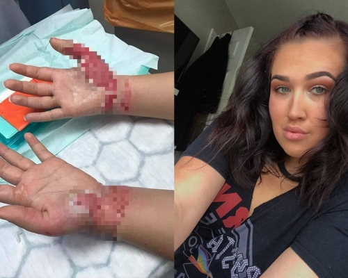 愛德華茲的手指三度燒傷。網圖