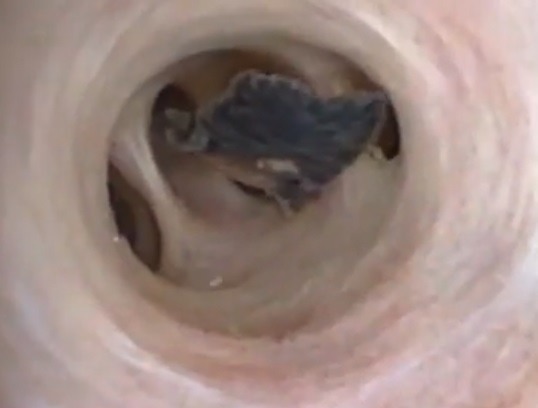 總共有5條寄生蟲(圖片來源:新英格蘭醫學期刊)