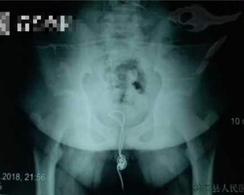 USB線在膀胱打了死結。片段截圖