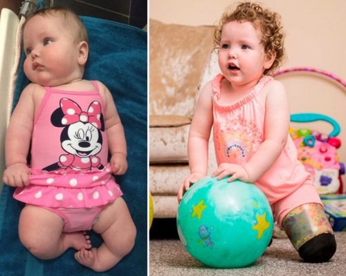 天生無脛骨僅靠雙膝爬行，英國3歲女童截肢後終學會走路。（網圖）