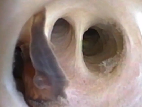 有寄生蟲在患者膽管內蠕動(圖片來源:新英格蘭醫學期刊)