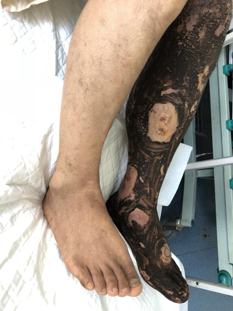 男子左腳出現瘀血斑點，一直蔓延到大腿根部，腳背腫脹。