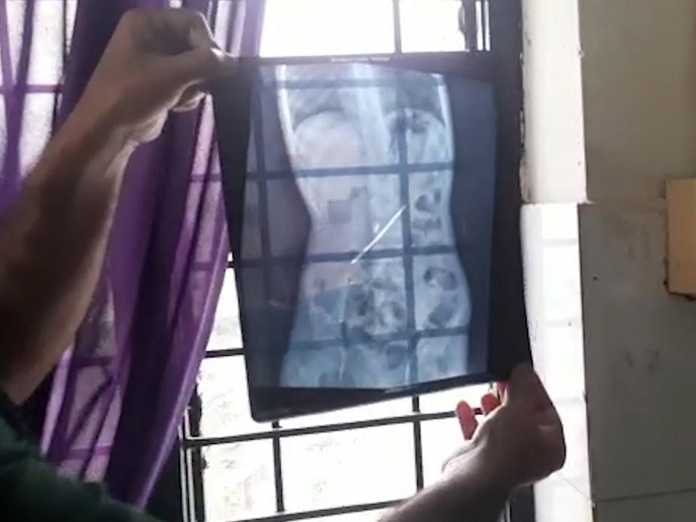 醫生看見哈里斯的腹部X光片都感到驚訝。網圖