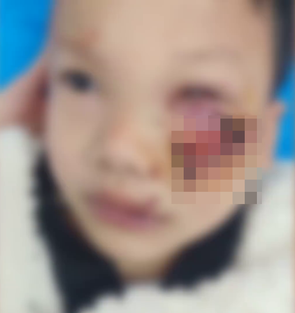 江西8歲男童遭狗咬，臉上縫90多針幾乎毀容。