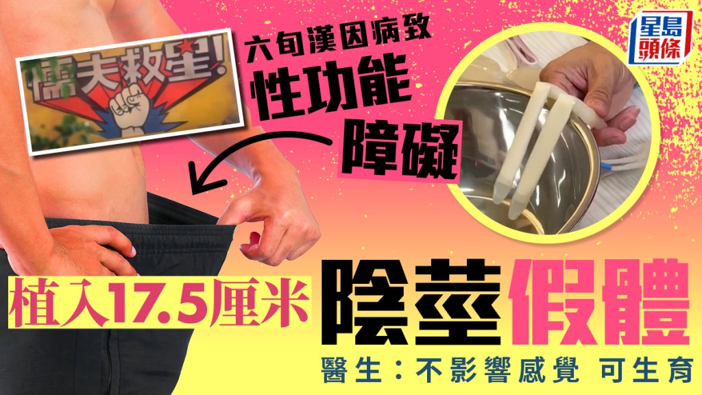 六旬漢植17.5cm陰莖假體重振雄風  網民質疑年紀大老婆卻力撐