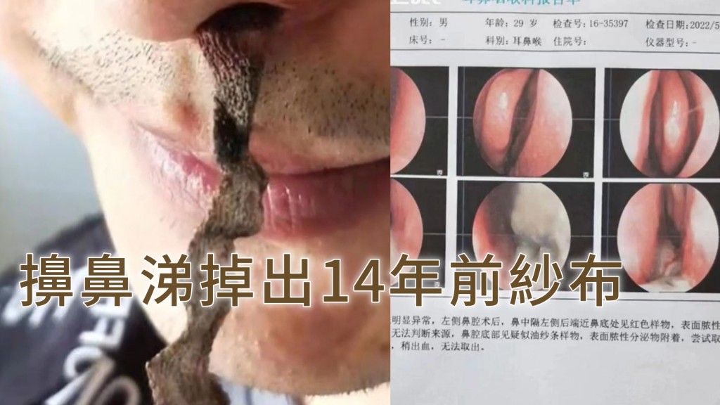 男子擤鼻涕掉出長12厘米紗布 。網圖