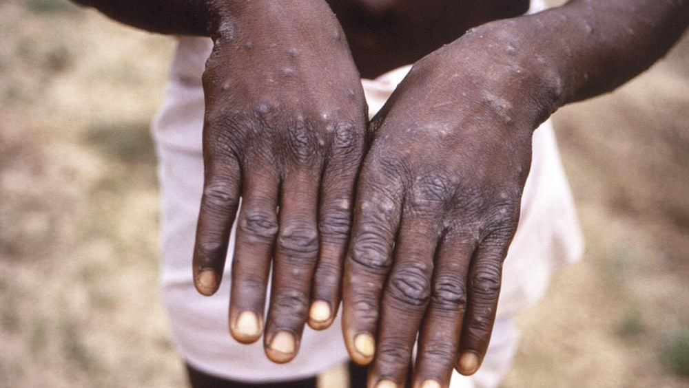 世界卫生组织宣布将猴痘改名「mpox」，以避免种族歧视。AP